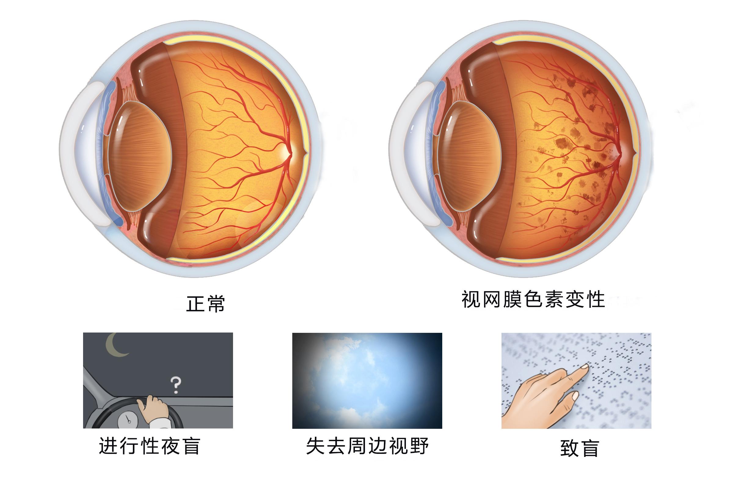 视网膜色素变性最新研究，与自然美景的邂逅，探寻内心平和之旅